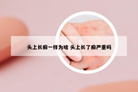 头上长癣一样为啥 头上长了癣严重吗