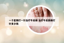 一个星期打一针治疗牛皮癣 治疗牛皮肤癣打针多少钱