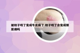 被蚊子咬了变成牛皮癣了 蚊子咬了会变成银屑病吗
