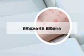银屑病凉水洗头 银屑病热水