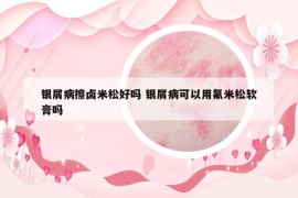 银屑病擦卤米松好吗 银屑病可以用氟米松软膏吗