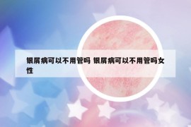 银屑病可以不用管吗 银屑病可以不用管吗女性