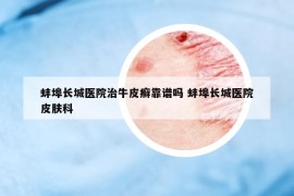 蚌埠长城医院治牛皮癣靠谱吗 蚌埠长城医院皮肤科