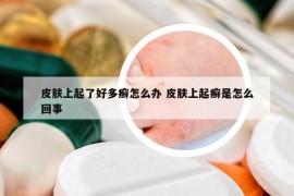 皮肤上起了好多癣怎么办 皮肤上起癣是怎么回事
