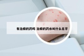 有治癣的药吗 治癣的药水叫什么名字