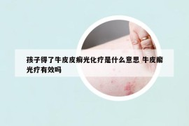 孩子得了牛皮皮癣光化疗是什么意思 牛皮廨光疗有效吗