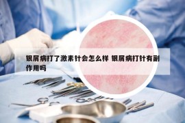 银屑病打了激素针会怎么样 银屑病打针有副作用吗
