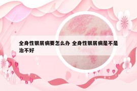 全身性银屑病要怎么办 全身性银屑病是不是治不好