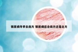银屑病冬季去南方 银屑病适合南方还是北方