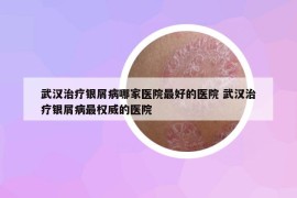 武汉治疗银屑病哪家医院最好的医院 武汉治疗银屑病最权威的医院