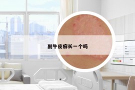副牛皮癣长一个吗