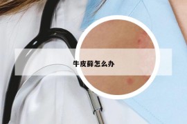 牛皮藓怎么办
