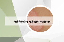 毒癣膏的作用 毒癣膏的作用是什么