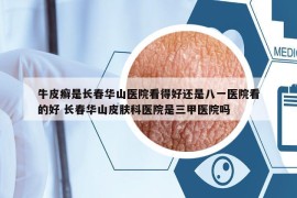 牛皮癣是长春华山医院看得好还是八一医院看的好 长春华山皮肤科医院是三甲医院吗
