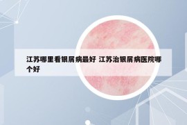江苏哪里看银屑病最好 江苏治银屑病医院哪个好