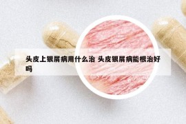 头皮上银屑病用什么治 头皮银屑病能根治好吗