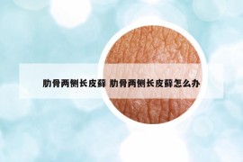 肋骨两侧长皮藓 肋骨两侧长皮藓怎么办