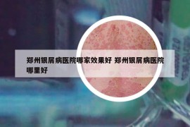 郑州银屑病医院哪家效果好 郑州银屑病医院哪里好