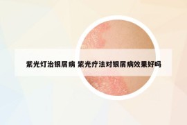 紫光灯治银屑病 紫光疗法对银屑病效果好吗