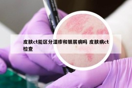 皮肤ct能区分湿疹和银屑病吗 皮肤病ct检查