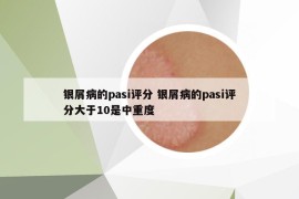 银屑病的pasi评分 银屑病的pasi评分大于10是中重度