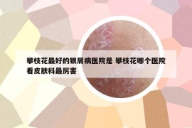 攀枝花最好的银屑病医院是 攀枝花哪个医院看皮肤科最厉害