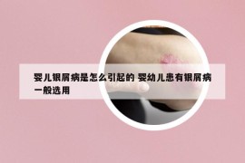 婴儿银屑病是怎么引起的 婴幼儿患有银屑病一般选用
