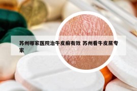 苏州哪家医院治牛皮癣有效 苏州看牛皮屑专家