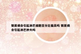 银屑病会引起淋巴细胞百分比偏高吗 银屑病会引起淋巴肿大吗