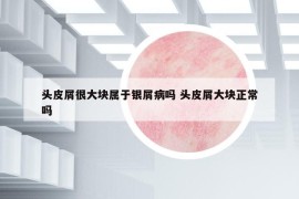 头皮屑很大块属于银屑病吗 头皮屑大块正常吗