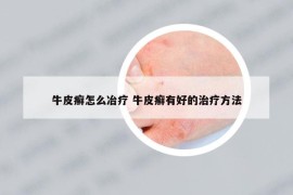 牛皮癣怎么冶疗 牛皮癣有好的治疗方法