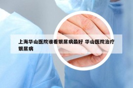 上海华山医院谁看银屑病最好 华山医院治疗银屑病