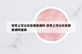世界上可以攻克银屑病吗 世界上可以攻克银屑病吗视频
