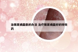 治银屑病最新的办法 治疗银屑病最好的特效药
