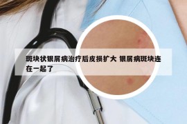 斑块状银屑病治疗后皮损扩大 银屑病斑块连在一起了