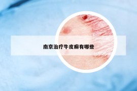 南京治疗牛皮癣有哪些