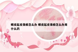 眼皮起皮像癣怎么办 眼皮起皮像癣怎么办用什么药