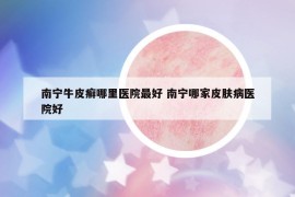 南宁牛皮癣哪里医院最好 南宁哪家皮肤病医院好