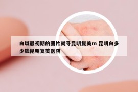 白斑最初期的图片就寻昆明复美m 昆明白多少钱昆明复美医院