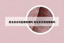 脱毛膏会引起银屑病吗 脱毛膏会腐蚀银器吗