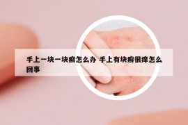 手上一块一块癣怎么办 手上有块癣很痒怎么回事