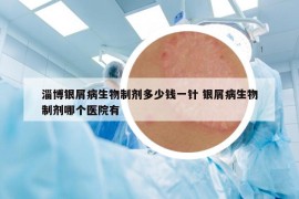 淄博银屑病生物制剂多少钱一针 银屑病生物制剂哪个医院有