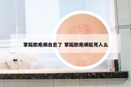 掌跖脓疱病自愈了 掌跖脓疱病能死人么