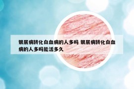 银屑病转化白血病的人多吗 银屑病转化白血病的人多吗能活多久