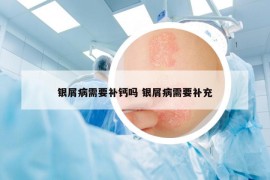 银屑病需要补钙吗 银屑病需要补充