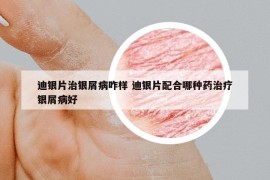 迪银片治银屑病咋样 迪银片配合哪种药治疗银屑病好