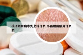 孩子银屑病睾丸上抹什么 小孩银屑病用什么药