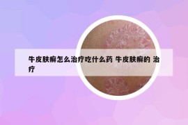 牛皮肤癣怎么治疗吃什么药 牛皮肤癣的 治疗
