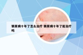 银屑病十年了怎么治疗 银屑病十年了能治疗吗