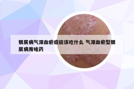 银屑病气滞血瘀症应该吃什么 气滞血瘀型银屑病用啥药